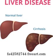 Free art print of Human liver. Cirrhosis. Human liver. Cirrhosis is a ...