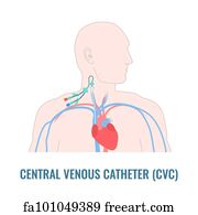 Free Tunneled Central Line Venous Catheter Close Up Art Prints and ...