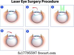 corneal ectasia