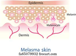 Free art print of Normal skin layer and melasma skin layer vector ...