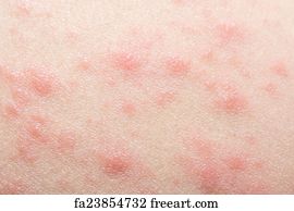 Free Vesicular Skin Rash Art Prints and Artworks | FreeArt